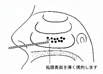 鼻の病気画像