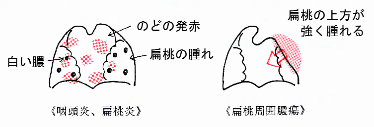 喉の病気画像