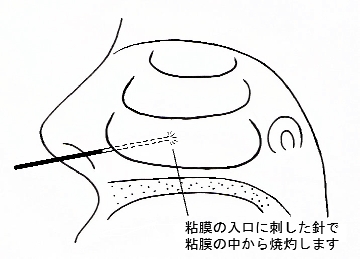 鼻の病気画像