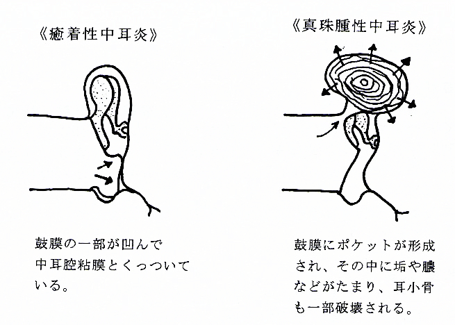 耳の病気画像